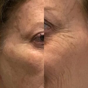HIFU COURSE – Beauty Course