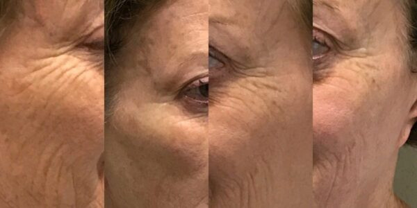 HIFU COURSE – Beauty Course